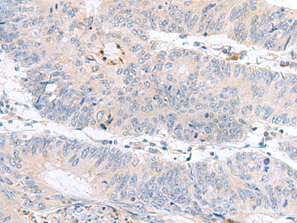 Immunohistochemistry of paraffin-embedded Human colorectal cancer tissue  using PDE6D Polyclonal Antibody at dilution of 1:60(×200)