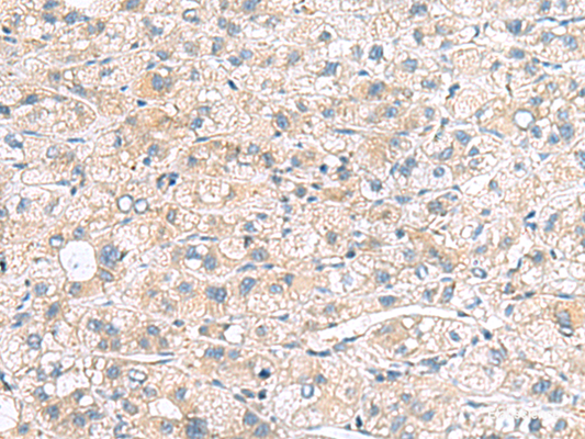 Immunohistochemistry of paraffin-embedded Human liver cancer tissue  using MYL1 Polyclonal Antibody at dilution of 1:75(×200)