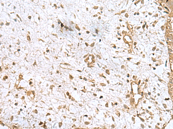 Immunohistochemistry of paraffin-embedded Human breast cancer tissue  using AK6 Polyclonal Antibody at dilution of 1:90(×200)