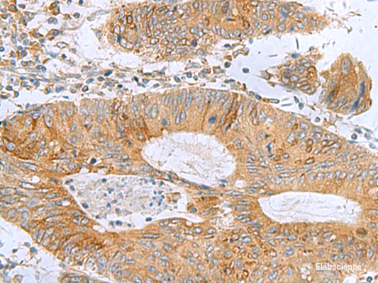 Immunohistochemistry of paraffin-embedded Human colorectal cancer tissue  using TXNDC12 Polyclonal Antibody at dilution of 1:60(×200)