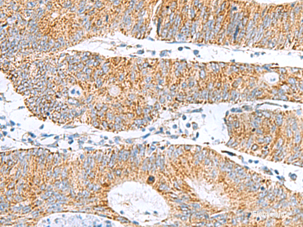 Immunohistochemistry of paraffin-embedded Human colorectal cancer tissue  using GCSH Polyclonal Antibody at dilution of 1:60(×200)