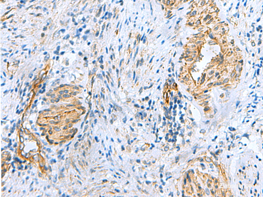 Immunohistochemistry of paraffin-embedded Human cervical cancer tissue  using NMU Polyclonal Antibody at dilution of 1:60(×200)