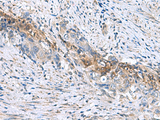 Immunohistochemistry of paraffin-embedded Human cervical cancer tissue  using RNF208 Polyclonal Antibody at dilution of 1:55(×200)