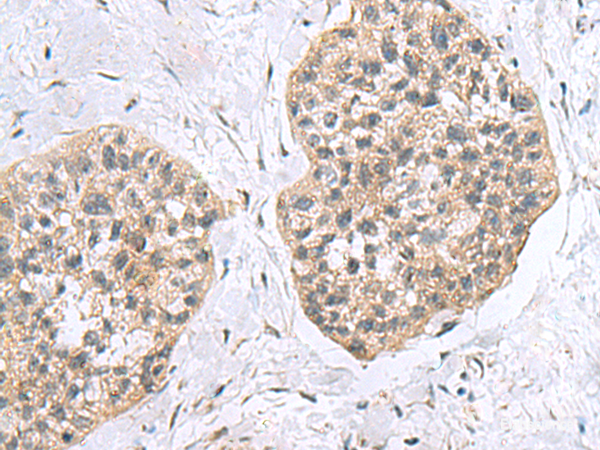 Immunohistochemistry of paraffin-embedded Human esophagus cancer tissue  using RPL18 Polyclonal Antibody at dilution of 1:60(×200)