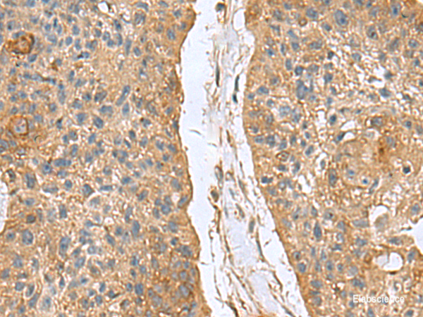 Immunohistochemistry of paraffin-embedded Human esophagus cancer tissue  using MARCKSL1 Polyclonal Antibody at dilution of 1:70(×200)