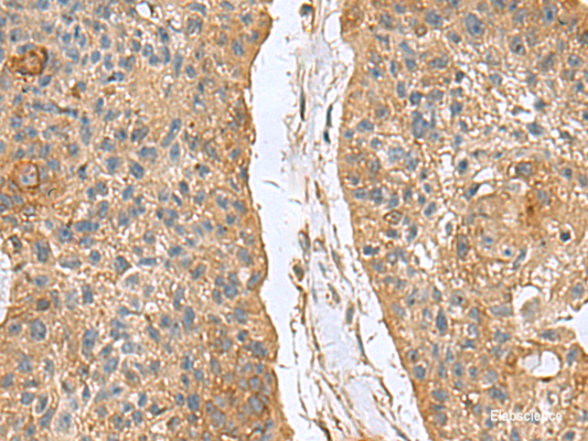 Immunohistochemistry of paraffin-embedded Human esophagus cancer tissue  using MARCKSL1 Polyclonal Antibody at dilution of 1:70(×200)