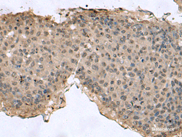 Immunohistochemistry of paraffin-embedded Human liver cancer tissue  using TMX3 Polyclonal Antibody at dilution of 1:60(×200)