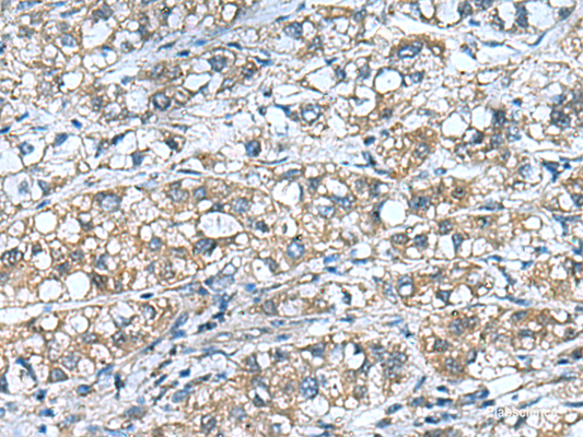Immunohistochemistry of paraffin-embedded Human liver cancer tissue  using COMMD9 Polyclonal Antibody at dilution of 1:55(×200)