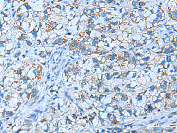 Immunohistochemistry of paraffin-embedded Human liver cancer tissue  using GUCA1A Polyclonal Antibody at dilution of 1:50(×200)