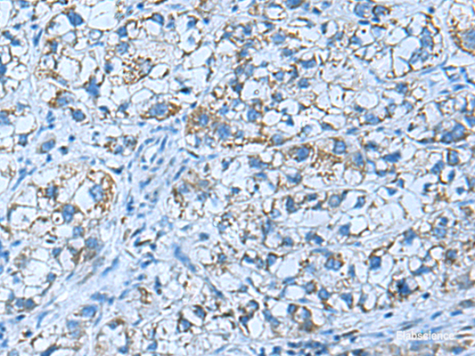 Immunohistochemistry of paraffin-embedded Human liver cancer tissue  using GUCA1A Polyclonal Antibody at dilution of 1:50(×200)