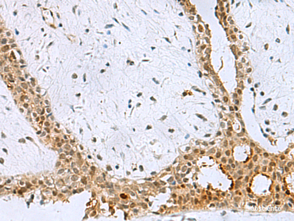 Immunohistochemistry of paraffin-embedded Human breast cancer tissue  using BCL7B Polyclonal Antibody at dilution of 1:60(×200)