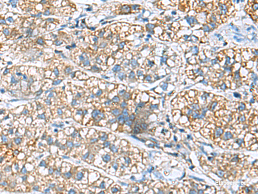 Immunohistochemistry of paraffin-embedded Human liver cancer tissue  using JOSD1 Polyclonal Antibody at dilution of 1:90(×200)
