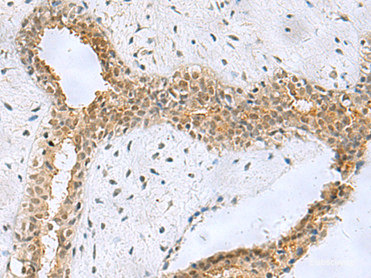 Immunohistochemistry of paraffin-embedded Human breast cancer tissue  using NABP1 Polyclonal Antibody at dilution of 1:50(×200)