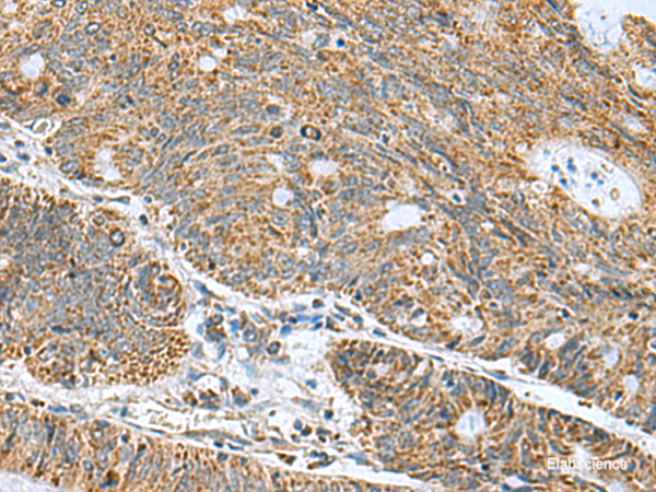 Immunohistochemistry of paraffin-embedded Human colorectal cancer tissue  using MRPL40 Polyclonal Antibody at dilution of 1:50(×200)