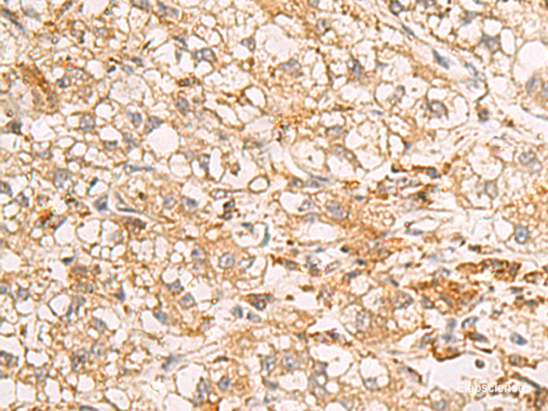 Immunohistochemistry of paraffin-embedded Human liver cancer tissue  using RAB38 Polyclonal Antibody at dilution of 1:50(×200)