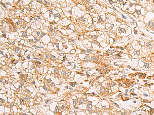 Immunohistochemistry of paraffin-embedded Human liver cancer tissue  using RAB38 Polyclonal Antibody at dilution of 1:50(×200)