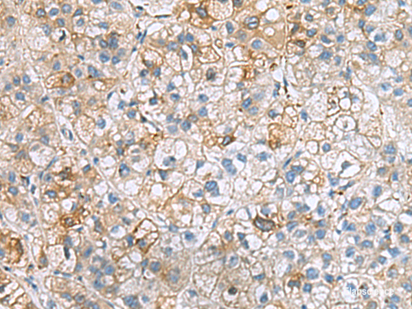 Immunohistochemistry of paraffin-embedded Human liver cancer tissue  using IGLL1 Polyclonal Antibody at dilution of 1:50(×200)