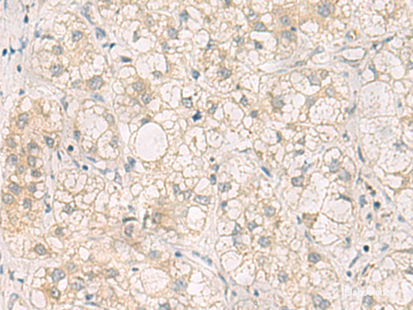 Immunohistochemistry of paraffin-embedded Human liver cancer tissue  using LRAT Polyclonal Antibody at dilution of 1:50(×200)