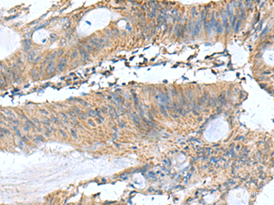 Immunohistochemistry of paraffin-embedded Human colorectal cancer tissue  using PAFAH1B3 Polyclonal Antibody at dilution of 1:60(×200)
