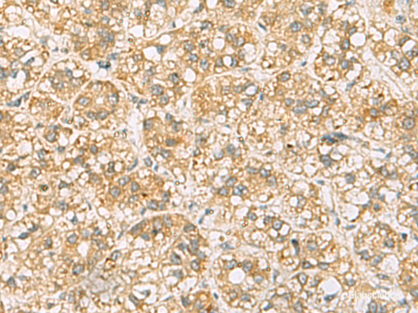 Immunohistochemistry of paraffin-embedded Human liver cancer tissue  using FAAP100 Polyclonal Antibody at dilution of 1:65(×200)