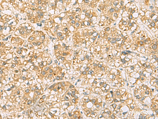 Immunohistochemistry of paraffin-embedded Human liver cancer tissue  using FAAP100 Polyclonal Antibody at dilution of 1:65(×200)