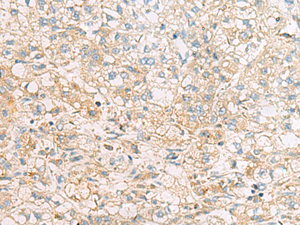 Immunohistochemistry of paraffin-embedded Human liver cancer tissue  using EIF4E2 Polyclonal Antibody at dilution of 1:50(×200)