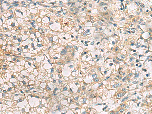 Immunohistochemistry of paraffin-embedded Human liver cancer tissue  using RTP4 Polyclonal Antibody at dilution of 1:50(×200)