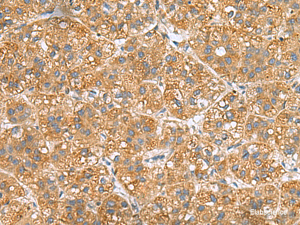 Immunohistochemistry of paraffin-embedded Human liver cancer tissue  using PPM1M Polyclonal Antibody at dilution of 1:50(×200)