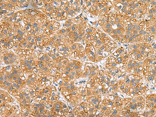 Immunohistochemistry of paraffin-embedded Human liver cancer tissue  using PPM1M Polyclonal Antibody at dilution of 1:50(×200)