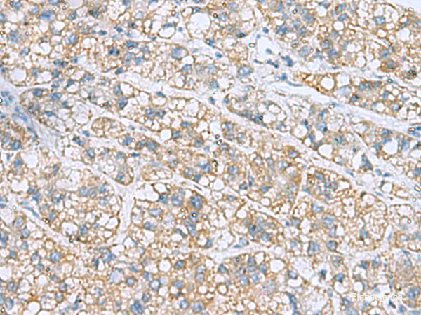 Immunohistochemistry of paraffin-embedded Human liver cancer tissue  using NANP Polyclonal Antibody at dilution of 1:50(×200)