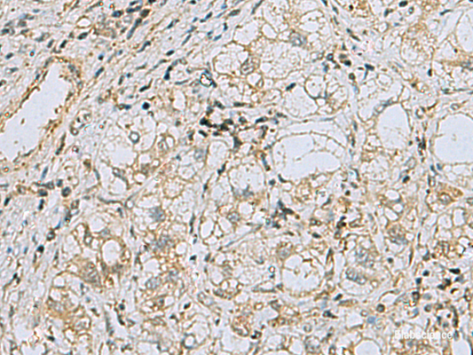Immunohistochemistry of paraffin-embedded Human liver cancer tissue  using RAB3IP Polyclonal Antibody at dilution of 1:60(×200)