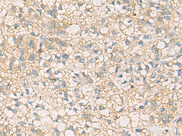 Immunohistochemistry of paraffin-embedded Human liver cancer tissue  using STX6 Polyclonal Antibody at dilution of 1:45(×200)