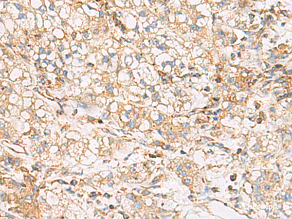 Immunohistochemistry of paraffin-embedded Human liver cancer tissue  using FYCO1 Polyclonal Antibody at dilution of 1:60(×200)