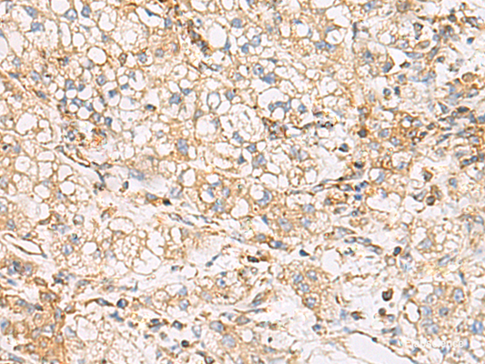 Immunohistochemistry of paraffin-embedded Human liver cancer tissue  using FYCO1 Polyclonal Antibody at dilution of 1:60(×200)