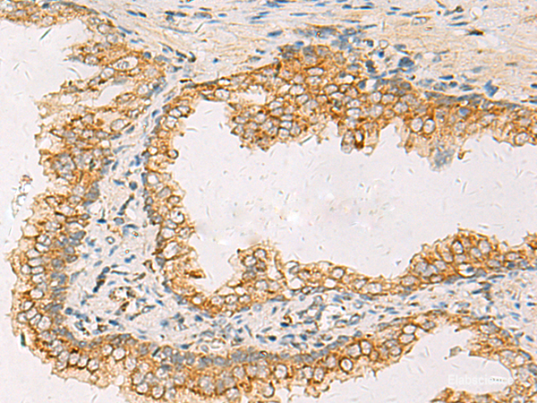 Immunohistochemistry of paraffin-embedded Human prost at e cancer tissue  using SUSD3 Polyclonal Antibody at dilution of 1:85(×200)