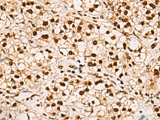 Immunohistochemistry of paraffin-embedded Human liver cancer tissue  using ELF5 Polyclonal Antibody at dilution of 1:75(×200)