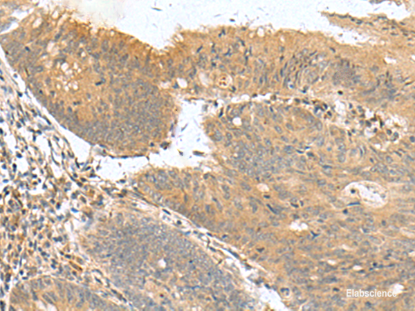 Immunohistochemistry of paraffin-embedded Human colorectal cancer tissue  using HHIPL2 Polyclonal Antibody at dilution of 1:50(×200)