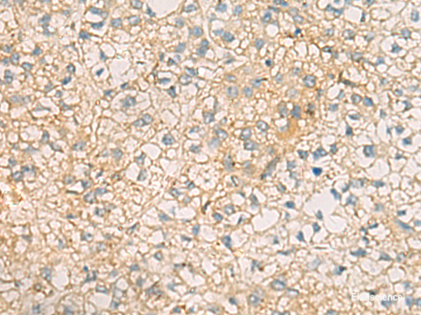 Immunohistochemistry of paraffin-embedded Human liver cancer tissue  using MRPL9 Polyclonal Antibody at dilution of 1:60(×200)