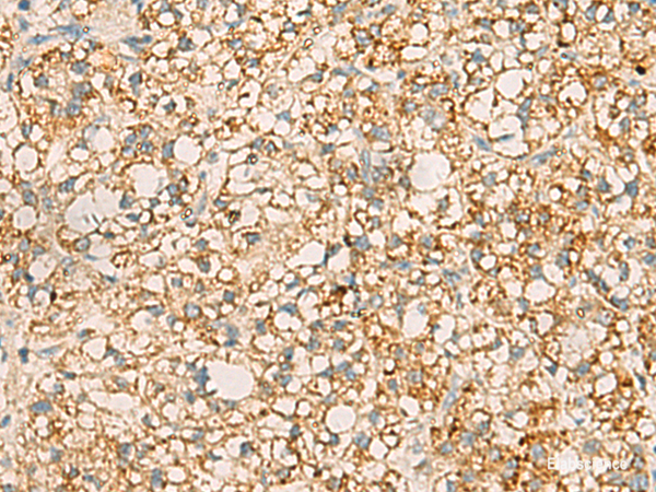 Immunohistochemistry of paraffin-embedded Human liver cancer tissue  using PDCL Polyclonal Antibody at dilution of 1:40(×200)
