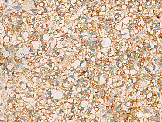 Immunohistochemistry of paraffin-embedded Human liver cancer tissue  using PDCL Polyclonal Antibody at dilution of 1:40(×200)