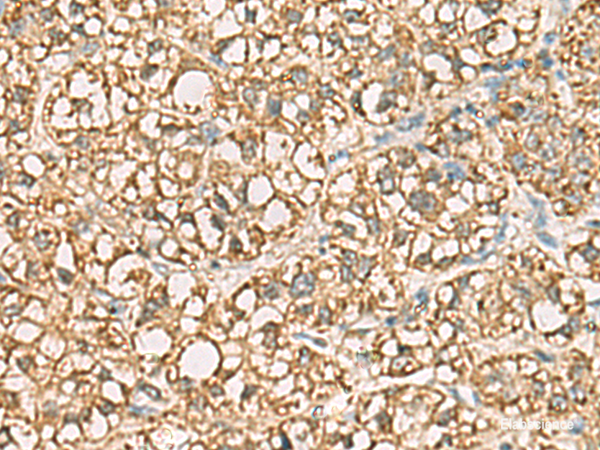 Immunohistochemistry of paraffin-embedded Human liver cancer tissue  using VTA1 Polyclonal Antibody at dilution of 1:85(×200)