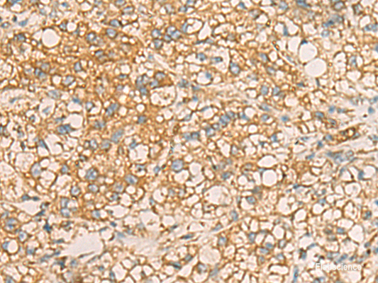 Immunohistochemistry of paraffin-embedded Human liver cancer tissue  using AIMP1 Polyclonal Antibody at dilution of 1:40(×200)