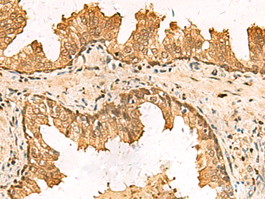 Immunohistochemistry of paraffin-embedded Human prost at e cancer tissue  using PDXK Polyclonal Antibody at dilution of 1:75(×200)