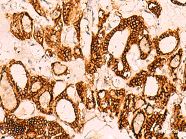 Immunohistochemistry of paraffin-embedded Human thyroid cancer tissue  using EPCAM Polyclonal Antibody at dilution of 1:40(×200)