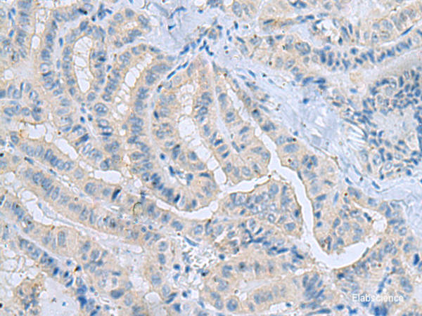 Immunohistochemistry of paraffin-embedded Human thyroid cancer tissue  using MSI2 Polyclonal Antibody at dilution of 1:70(×200)