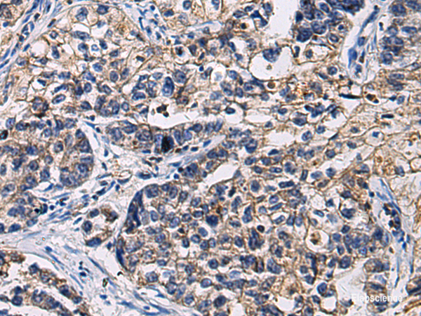 Immunohistochemistry of paraffin-embedded Human gastric cancer tissue  using SSH3 Polyclonal Antibody at dilution of 1:55(×200)