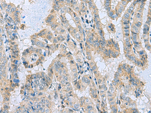 Immunohistochemistry of paraffin-embedded Human thyroid cancer tissue  using MGME1 Polyclonal Antibody at dilution of 1:50(×200)