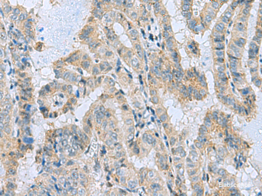 Immunohistochemistry of paraffin-embedded Human thyroid cancer tissue  using MGME1 Polyclonal Antibody at dilution of 1:50(×200)
