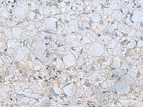 Immunohistochemistry of paraffin-embedded Human liver cancer tissue  using NAGK Polyclonal Antibody at dilution of 1:45(×200)