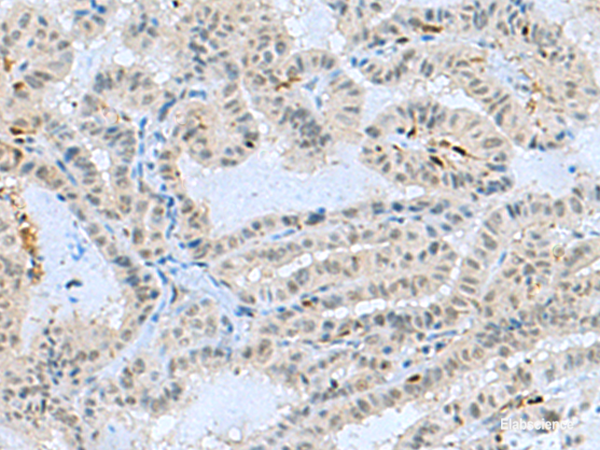 Immunohistochemistry of paraffin-embedded Human thyroid cancer tissue  using TCF19 Polyclonal Antibody at dilution of 1:60(×200)